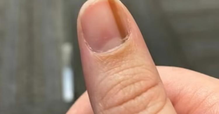 She Didn’t Think This Line On Her Thumb Was A Big Deal Until Doctors Told Her The Terrible News