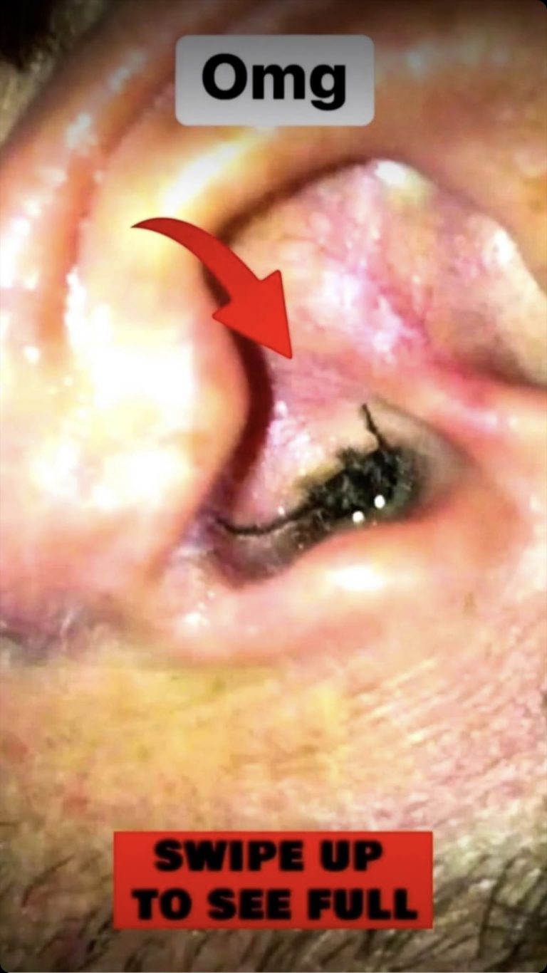 An enormous blackhead in the ear!