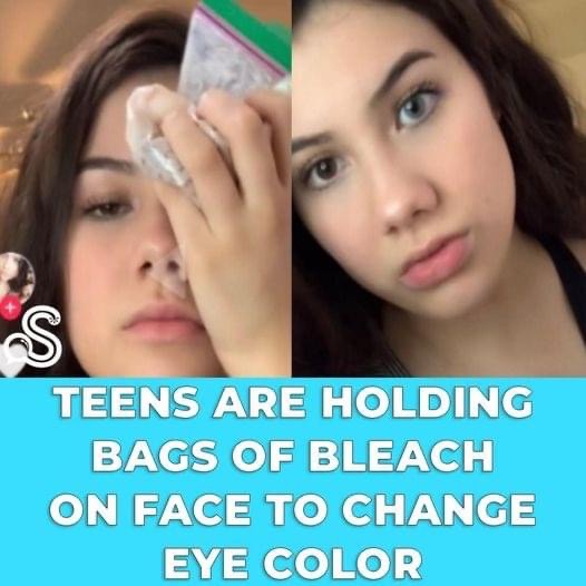 Teens Are Holding Bags Of Bleach On Face To Change Eye Color