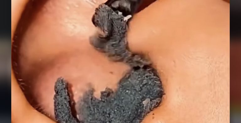 An enormous blackhead in