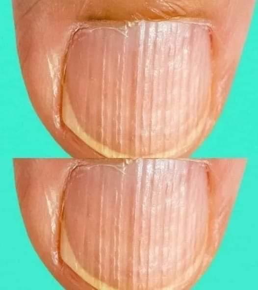 Having Striped Nails Could