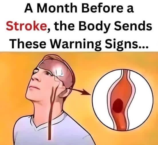 Attention… A Month Before a Stroke