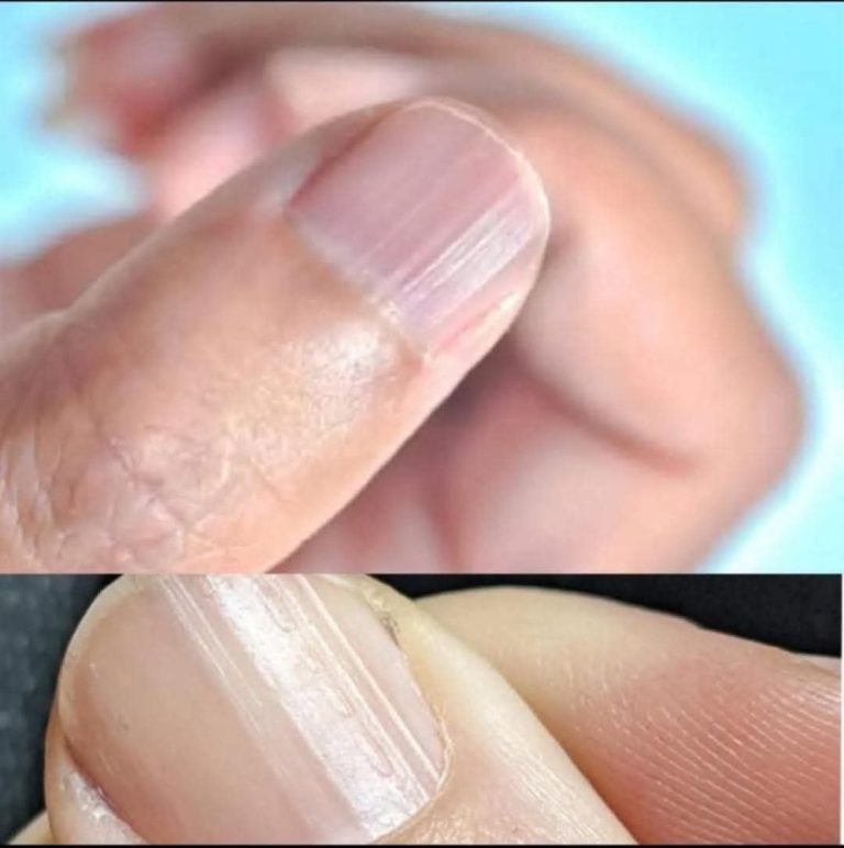 Rippled fingernails reveal secrets of possible disease