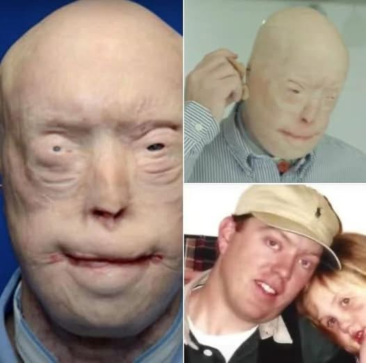 He suffered devastating burns when he tried to rescue a woman trapped in a fire. For years, he was terrified to show his face to the world, and wore caps, sunglasses and prosthetic ears in public.