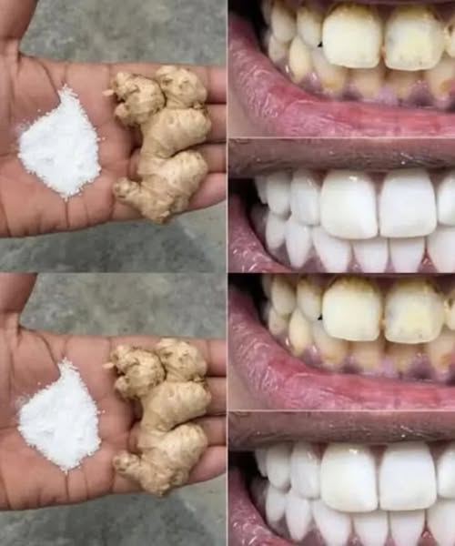 Whiten Your Teeth – Home Remedy with