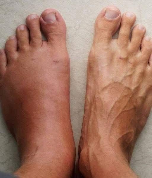 One Month Before a Heart Att.ack,