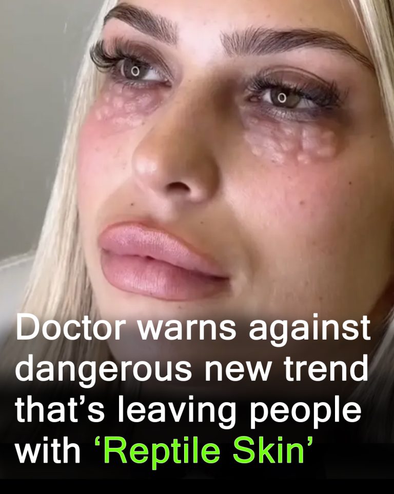 Doctors warn against beauty trend that causes