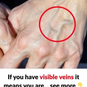 When to Worry About Veins That Appear Out of Nowhere