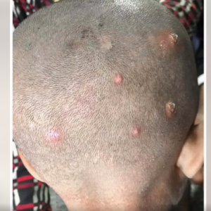 I Found Strange Bumps on My Son’s Head — Then Came