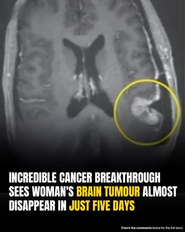 Woman’s Inoperable Brain Tumor