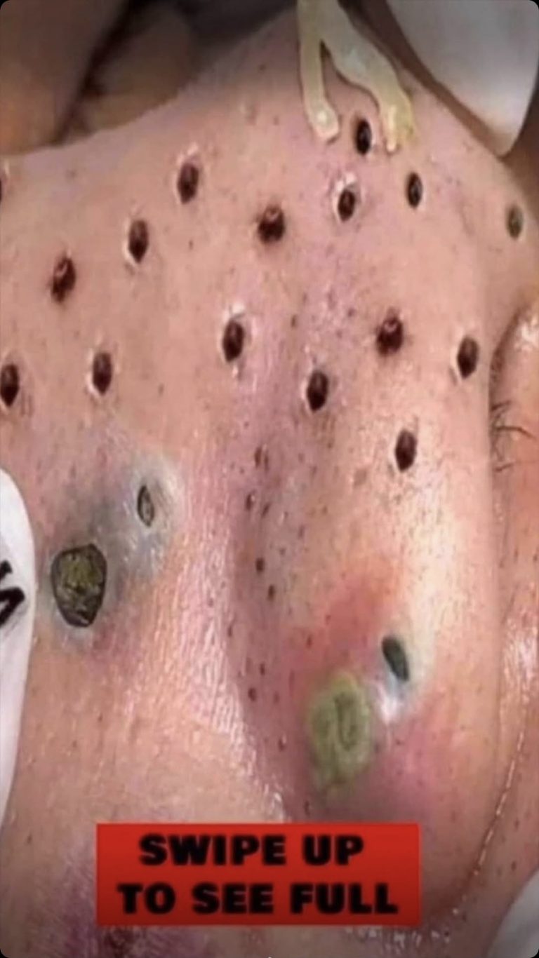 Their acne is severe