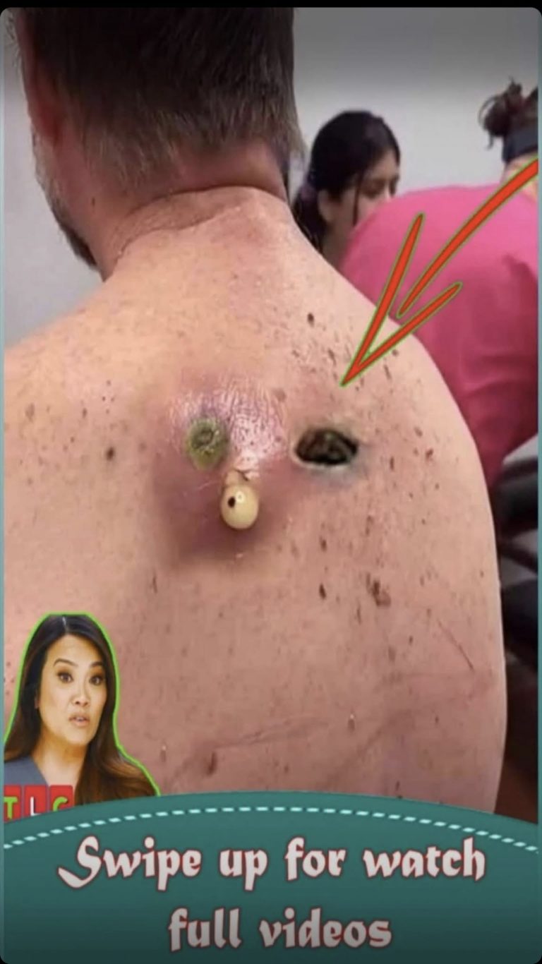 Acne And Everything You Need To