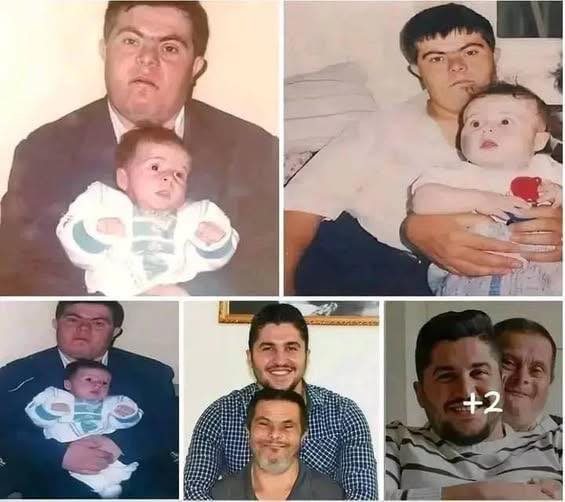 A father with Down syndrome raised his