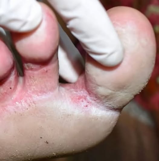 Looks like a infection between my toes. Can’t get