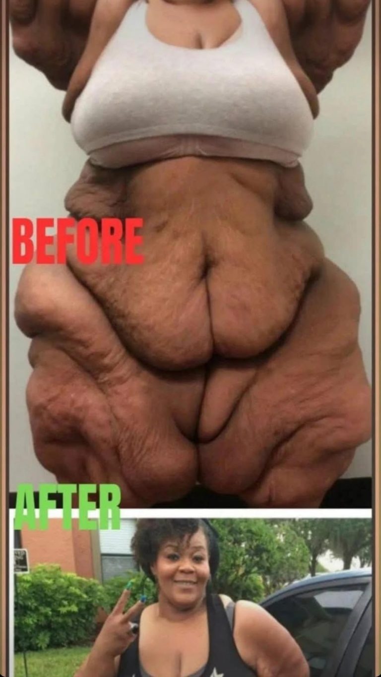 World’s heaviest woman who weighed 50 stone no