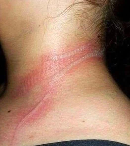 girl left with horrific burns on her neck