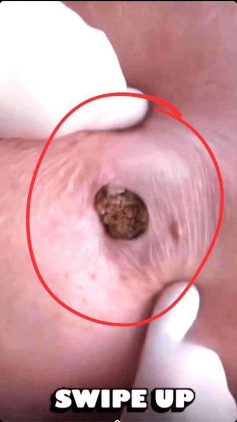 How to Treat Pimples: Gentle, Proven Solutions f