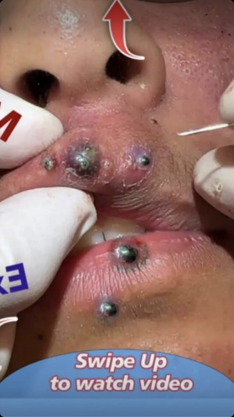 Acne And Everything You Need To Know About Them