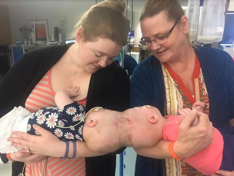 Siamese twin sisters were born with their h