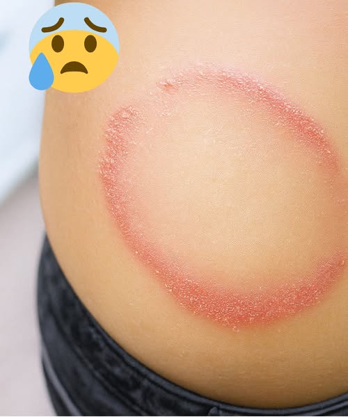 How to identify and cure skin fungus or ringworm.