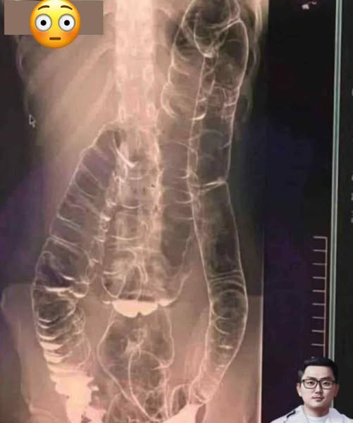 Everything you need to know about chronic constipation: A