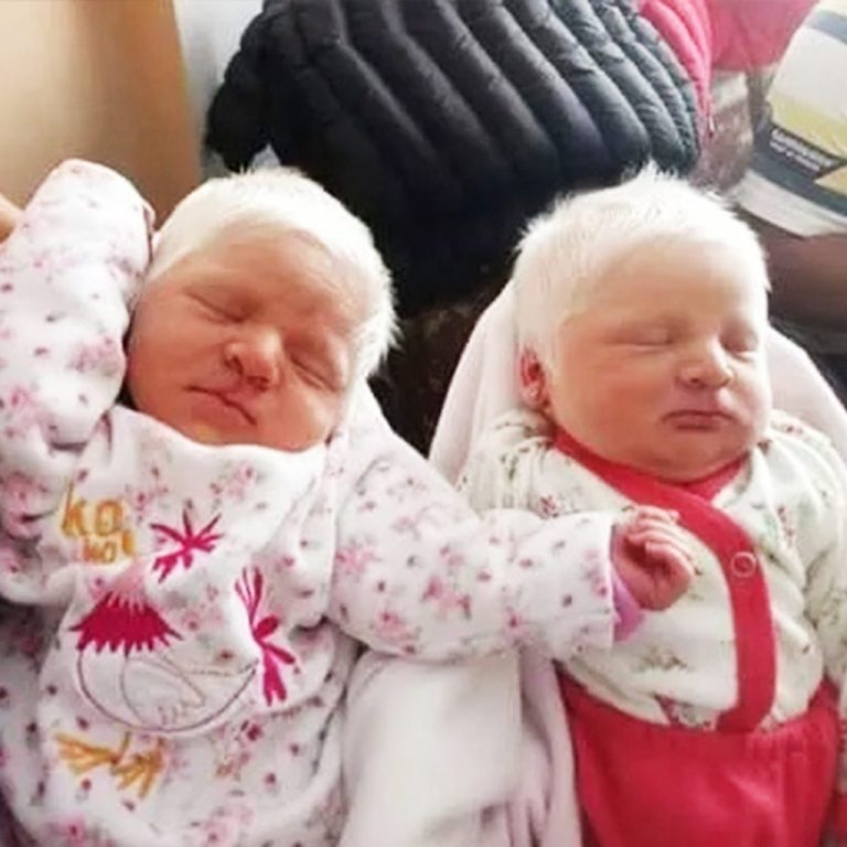 The First Ever Albino Twins Born In Argentina