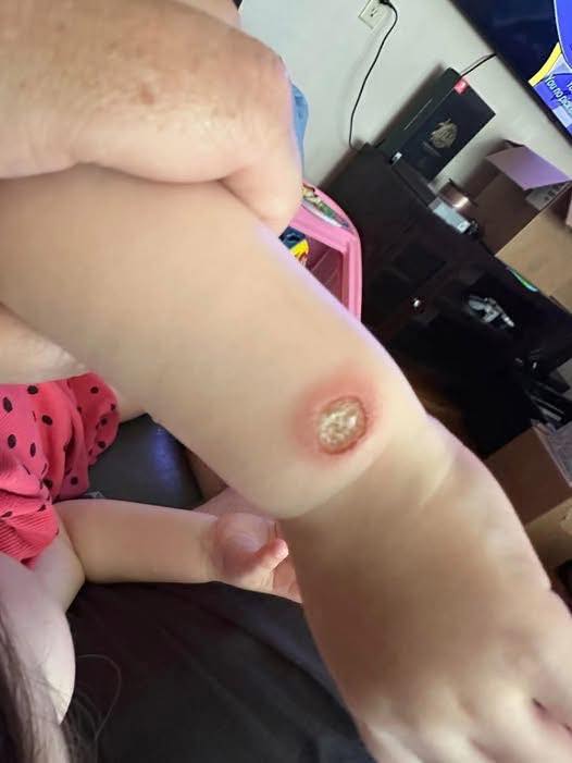 Unusual Case of Sweet Syndrome T