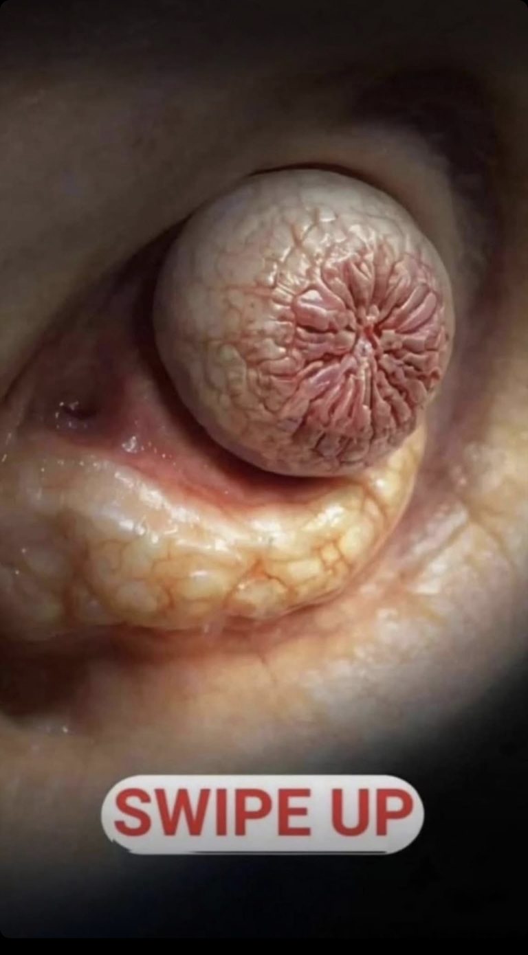 Their acne is severe