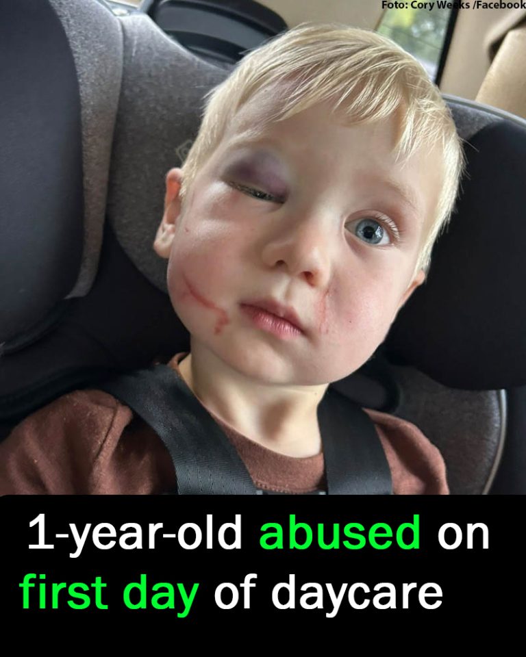 Daycare worker arrested after toddler arrives with black eye