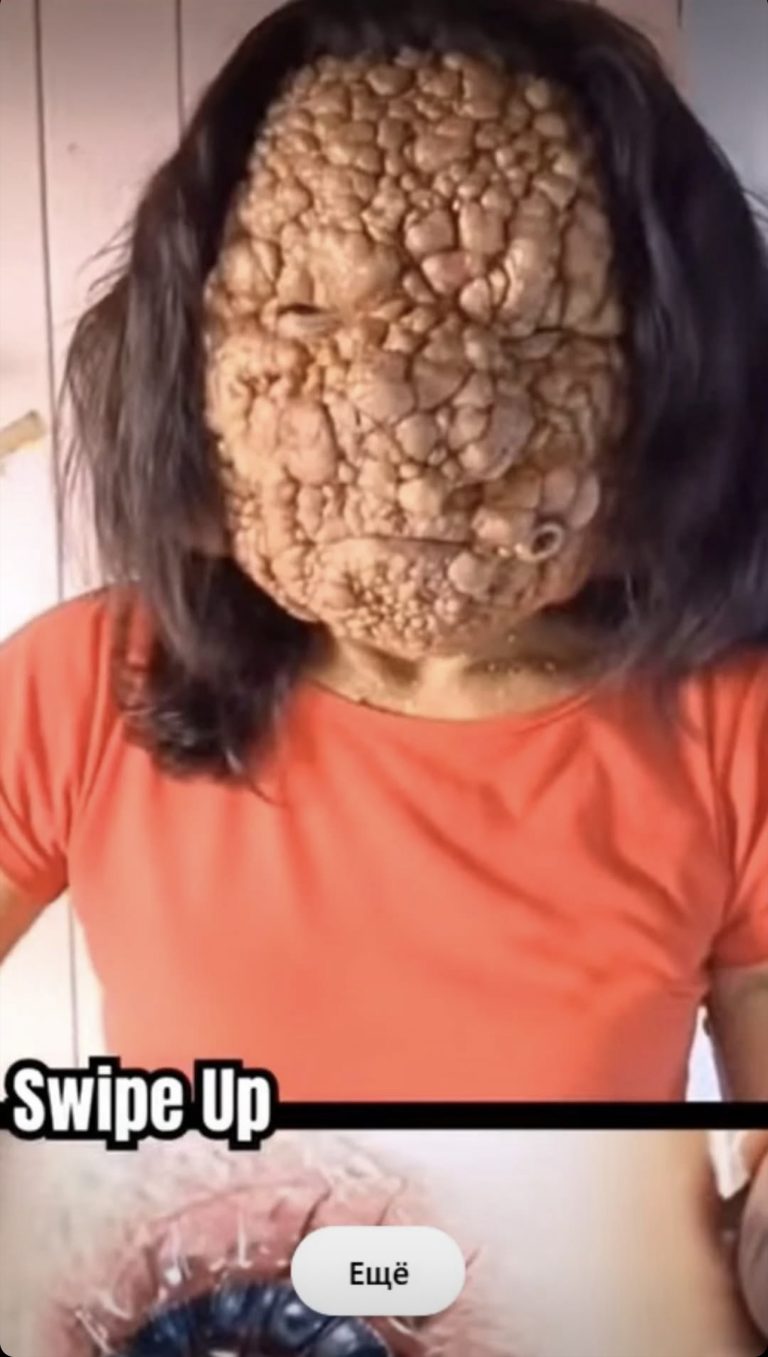 Acne occurs when hair follicles