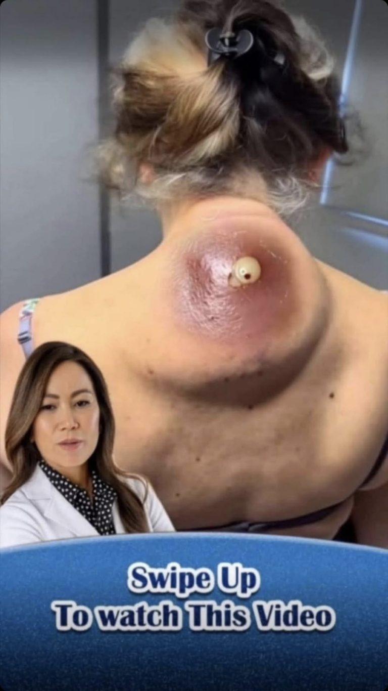 Their acne is severe