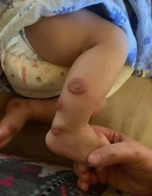 A Skin Condition with Whole-Body Effects