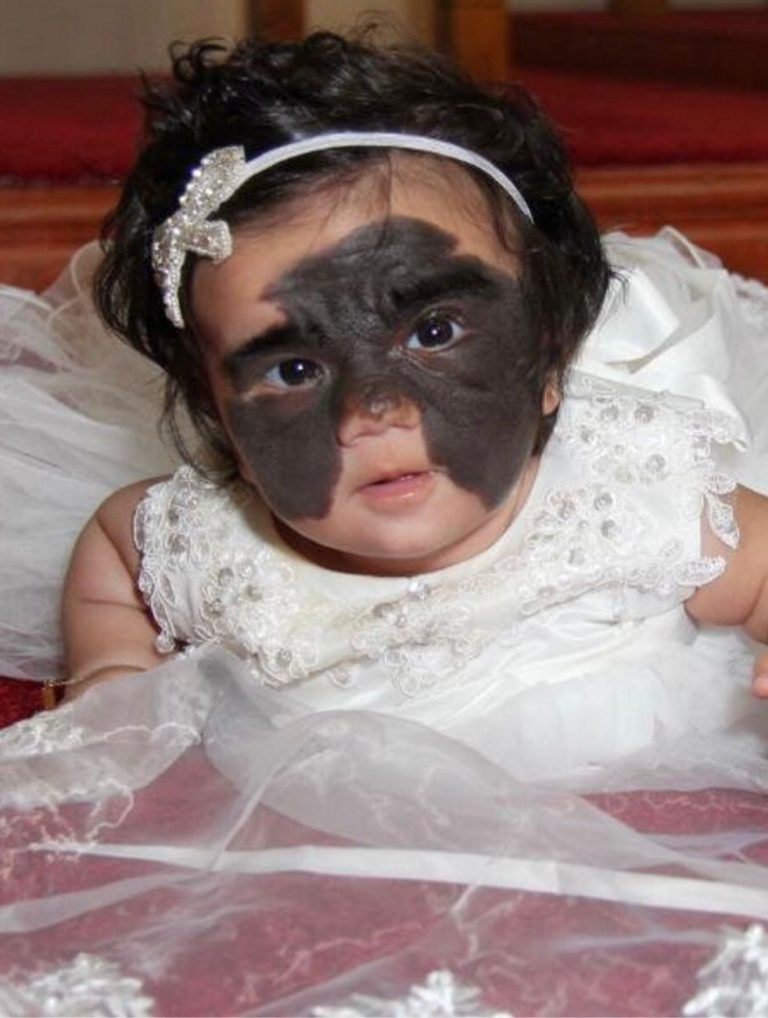 Girl With A ‘Batman Birthmark’ Finally Got It Removed With