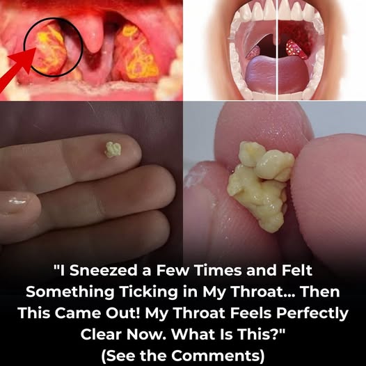 Everything you need know about tonsil stones, od