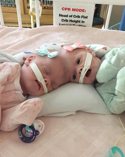 Conjoined twins Abby and Erin Delaney: