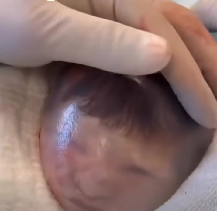 Baby born with an DIU peg