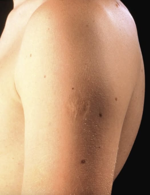 Smallpox vaccine scars: What they look li
